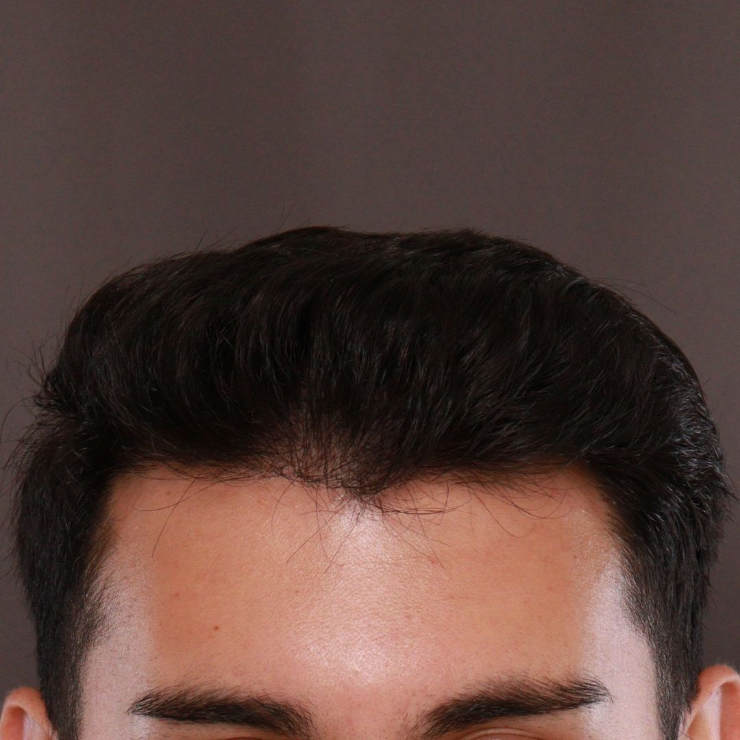 After Image: FUE Hair Transplant by Dr. Manning - front