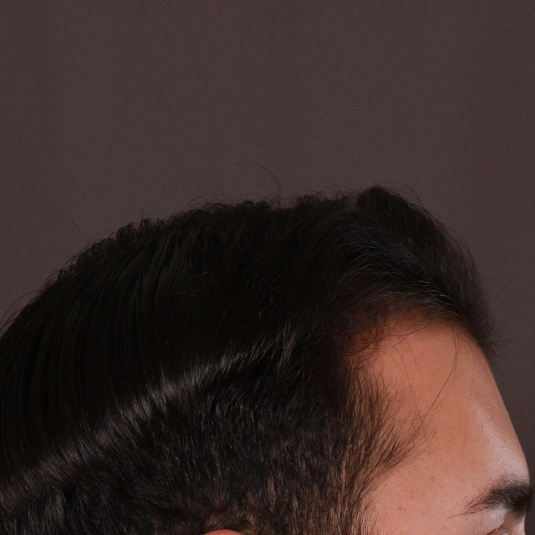 Before Image: FUE Hair Transplant by Dr. Manning -