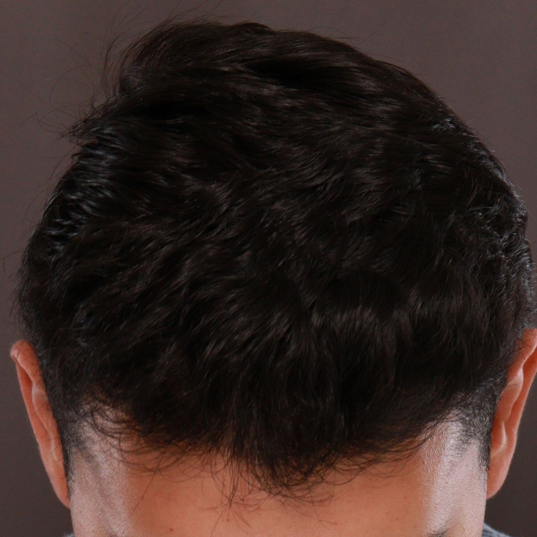 After Image: FUE Hair Transplant by Dr. Manning - front