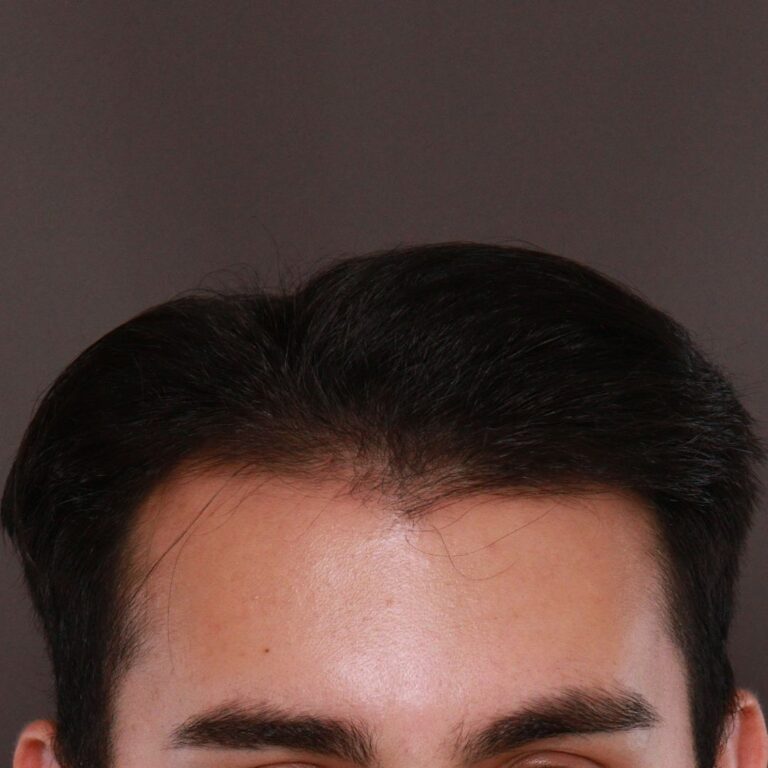 Before Image: FUE Hair Transplant by Dr. Manning - front