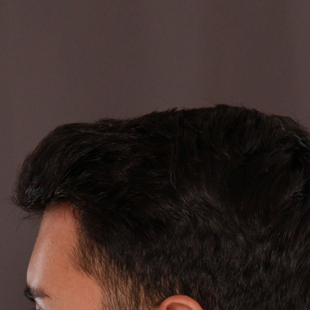 After Image: FUE Hair Transplant by Dr. Manning -