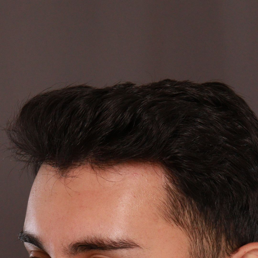 After Image: FUE Hair Transplant by Dr. Manning - right-front-oblique
