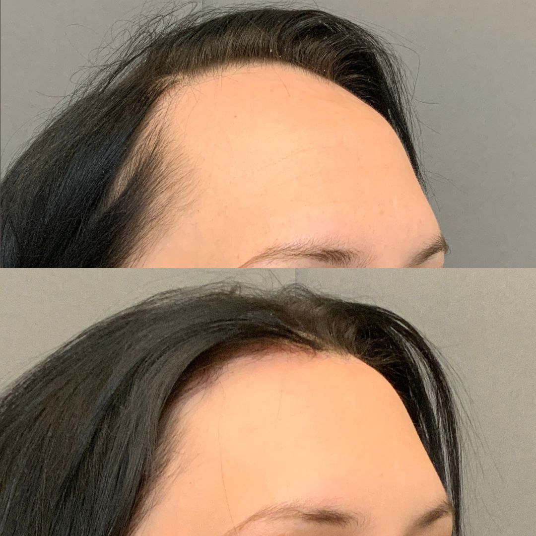 forehead reduction 1 forehead reduction 1