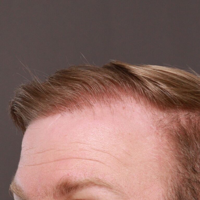 After Image: FUE Hair Transplant by Dr. Thompson - left-front-oblique