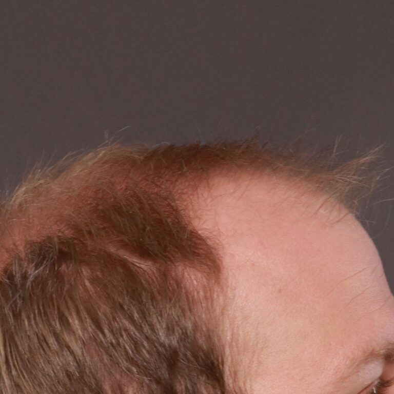 Before Image: FUE Hair Transplant by Dr. Thompson - right-side