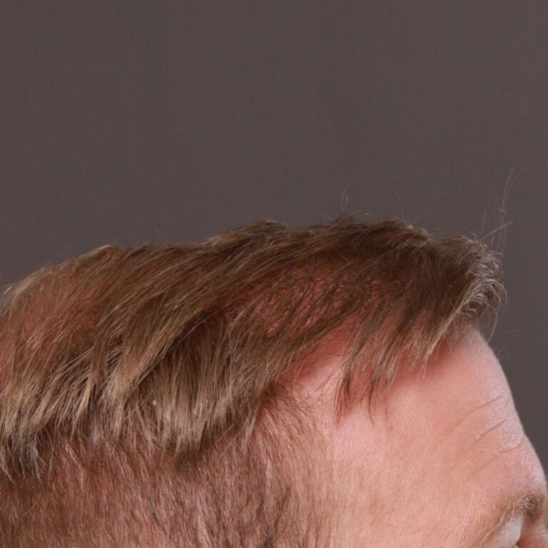 After Image: FUE Hair Transplant by Dr. Thompson - right-side