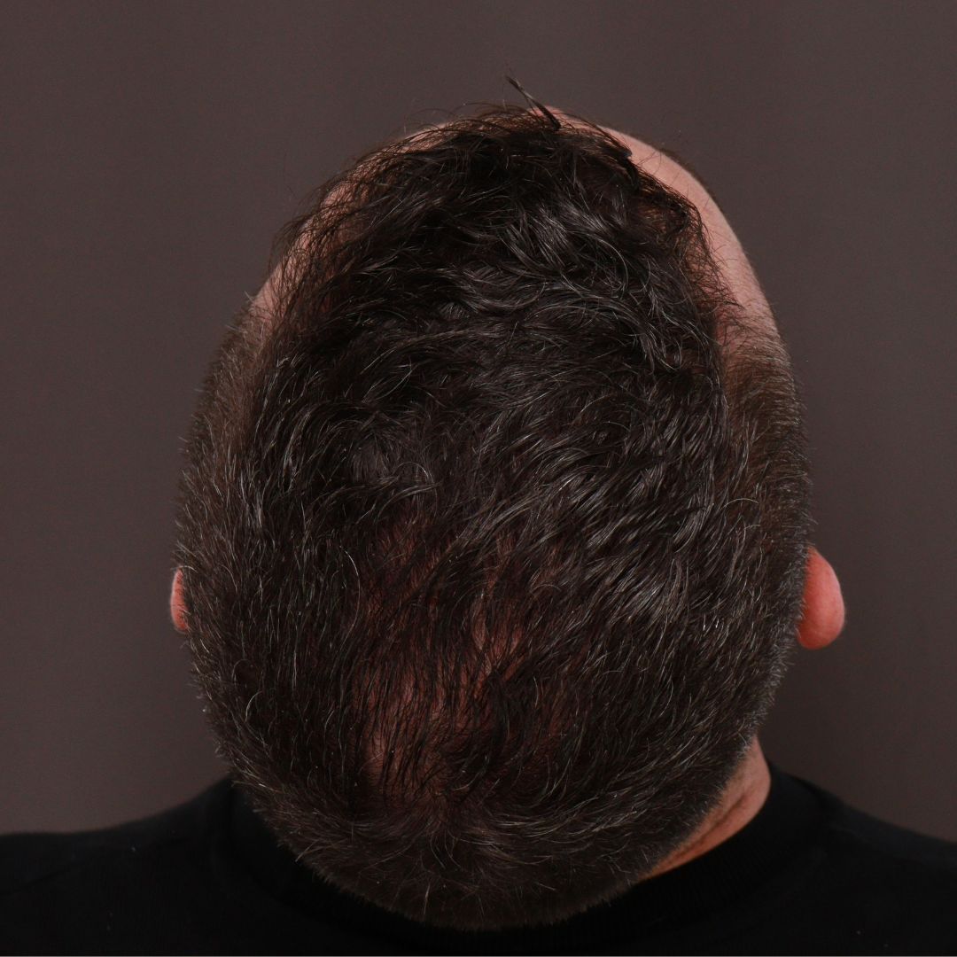 Before Image: FUE Hair Transplant by Dr. Manning - back