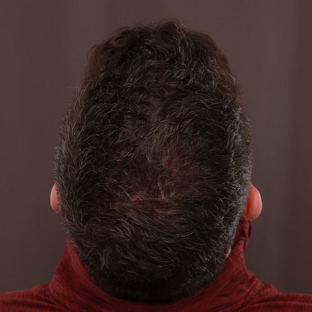 After Image: FUE Hair Transplant by Dr. Manning - back