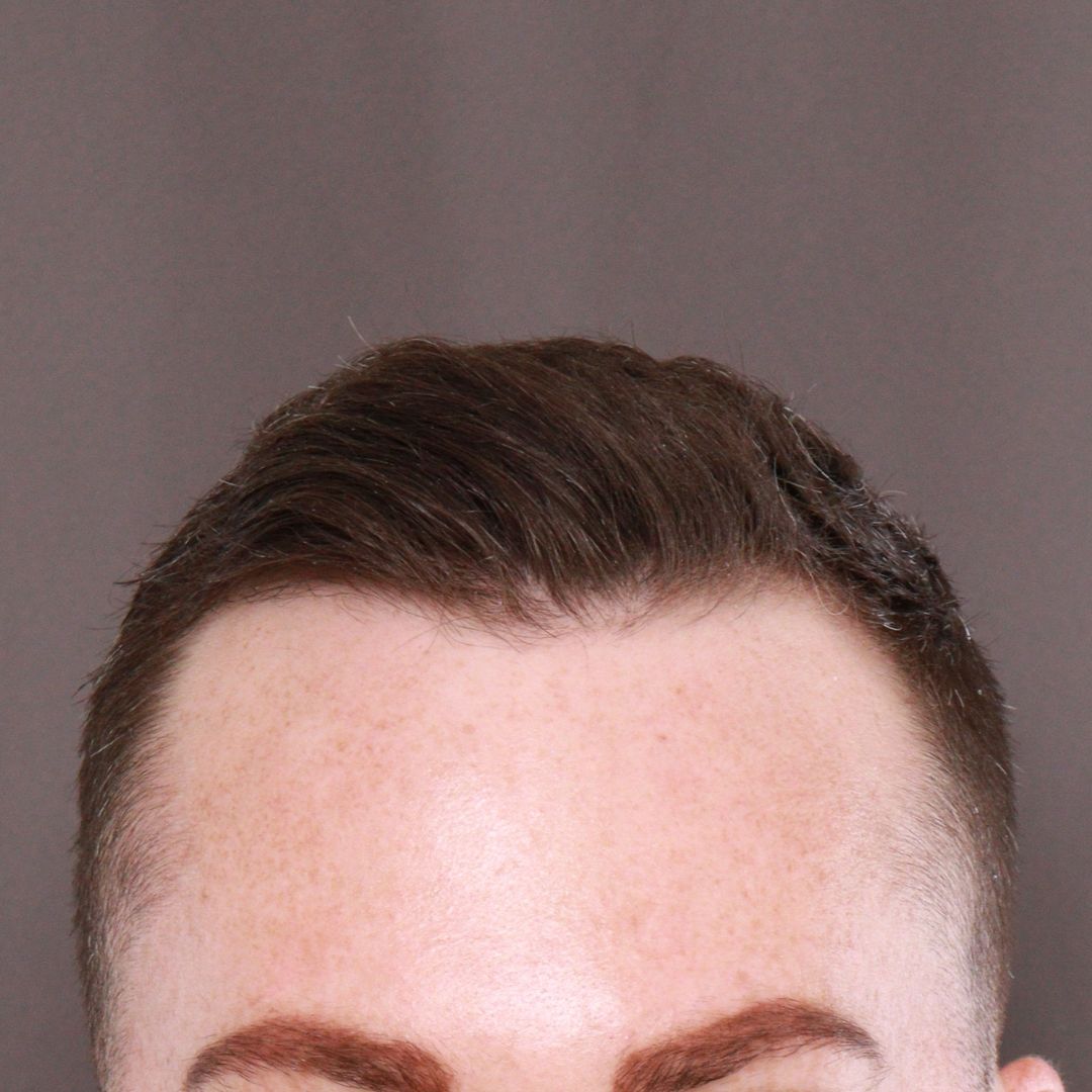 Before Image: FUE Hair Transplant by Dr. Manning - front