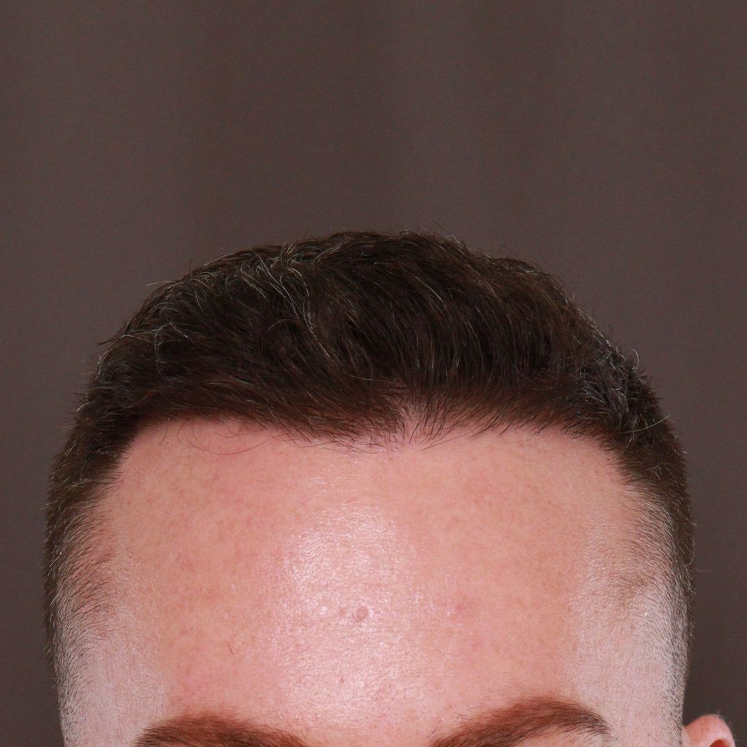 After Image: FUE Hair Transplant by Dr. Manning - front