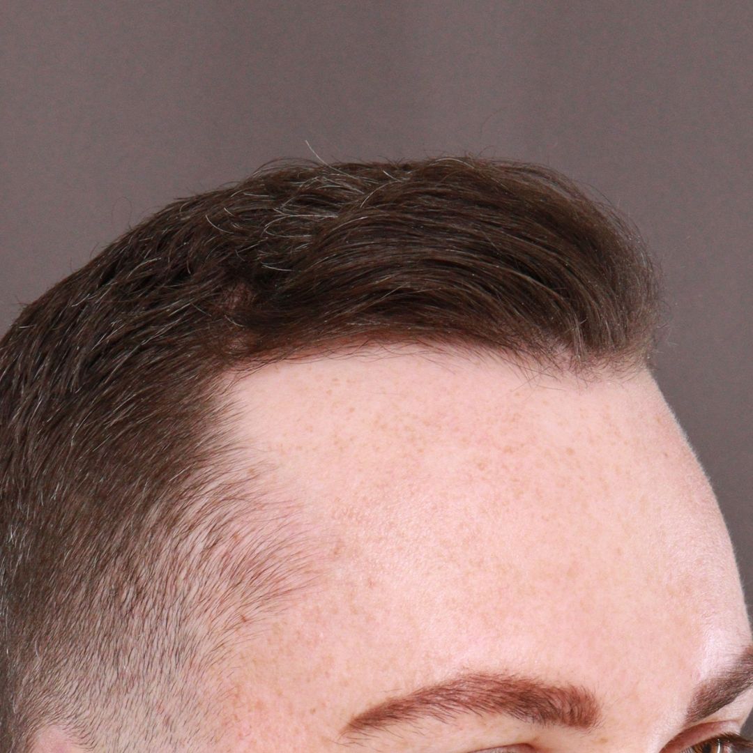 Before Image: FUE Hair Transplant by Dr. Manning - right-front-oblique