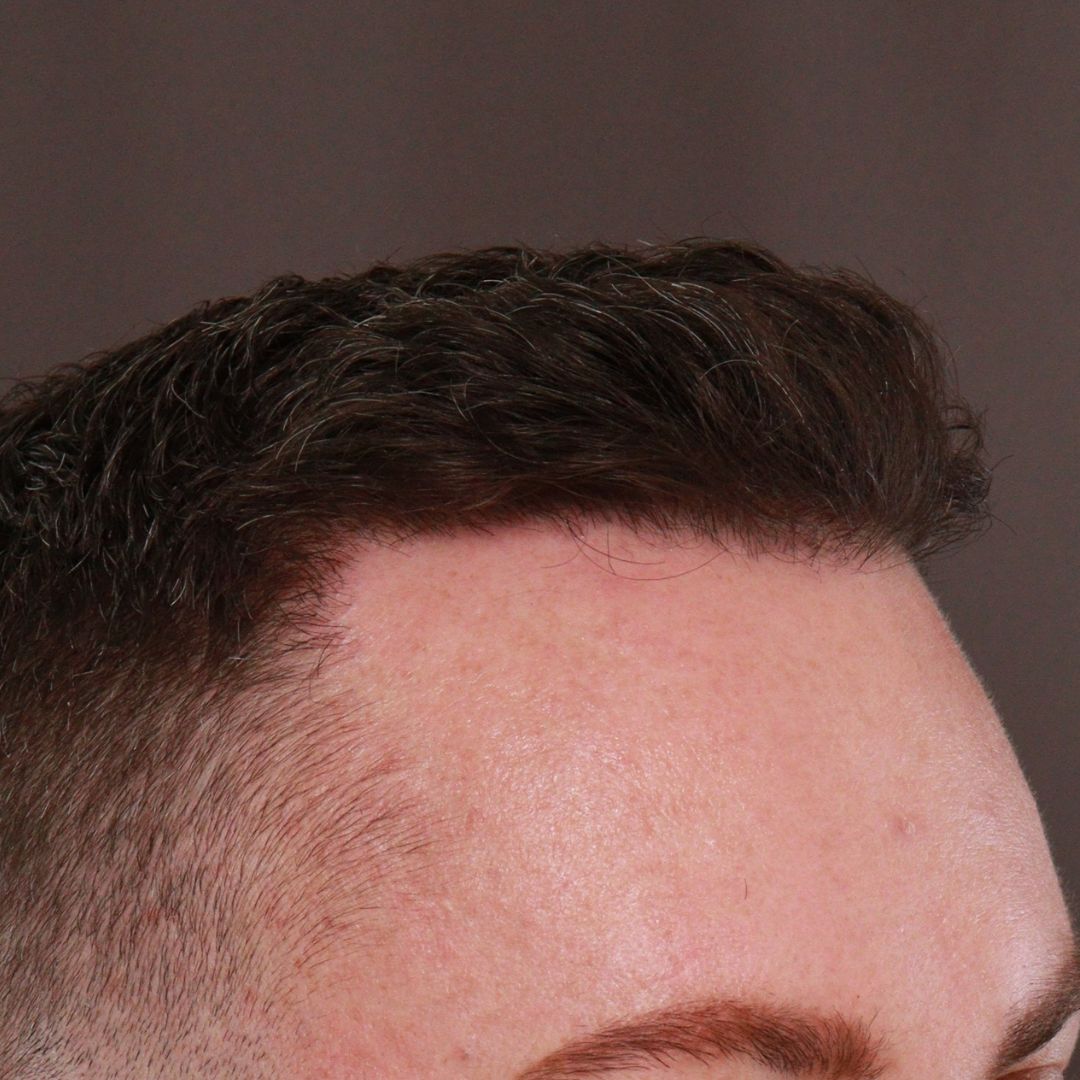After Image: FUE Hair Transplant by Dr. Manning - right-front-oblique