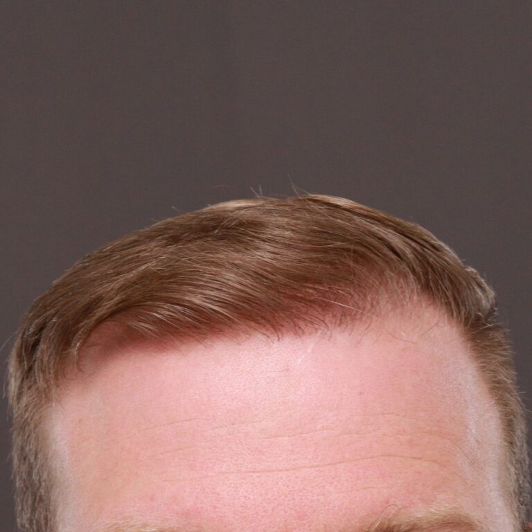 After Image: FUE Hair Transplant by Dr. Thompson - front
