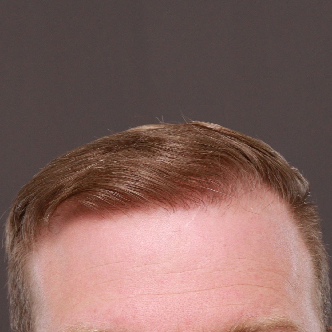 After Image: FUE Hair Transplant by Dr. Thompson - front
