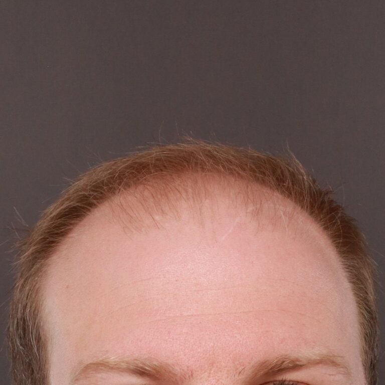 Before Image: FUE Hair Transplant by Dr. Thompson - front