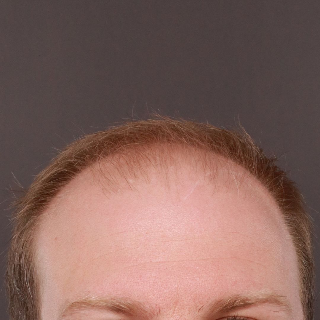 Before Image: FUE Hair Transplant by Dr. Thompson - front