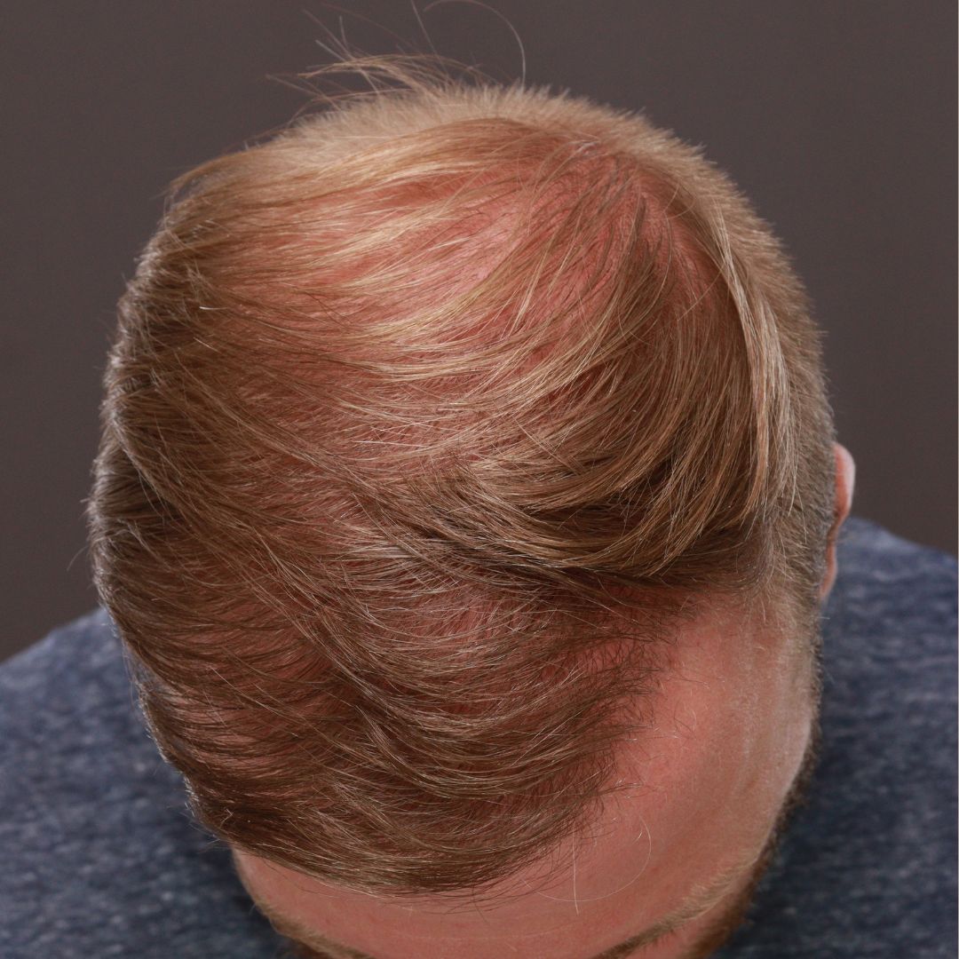 After Image: FUE Hair Transplant by Dr. Thompson - front