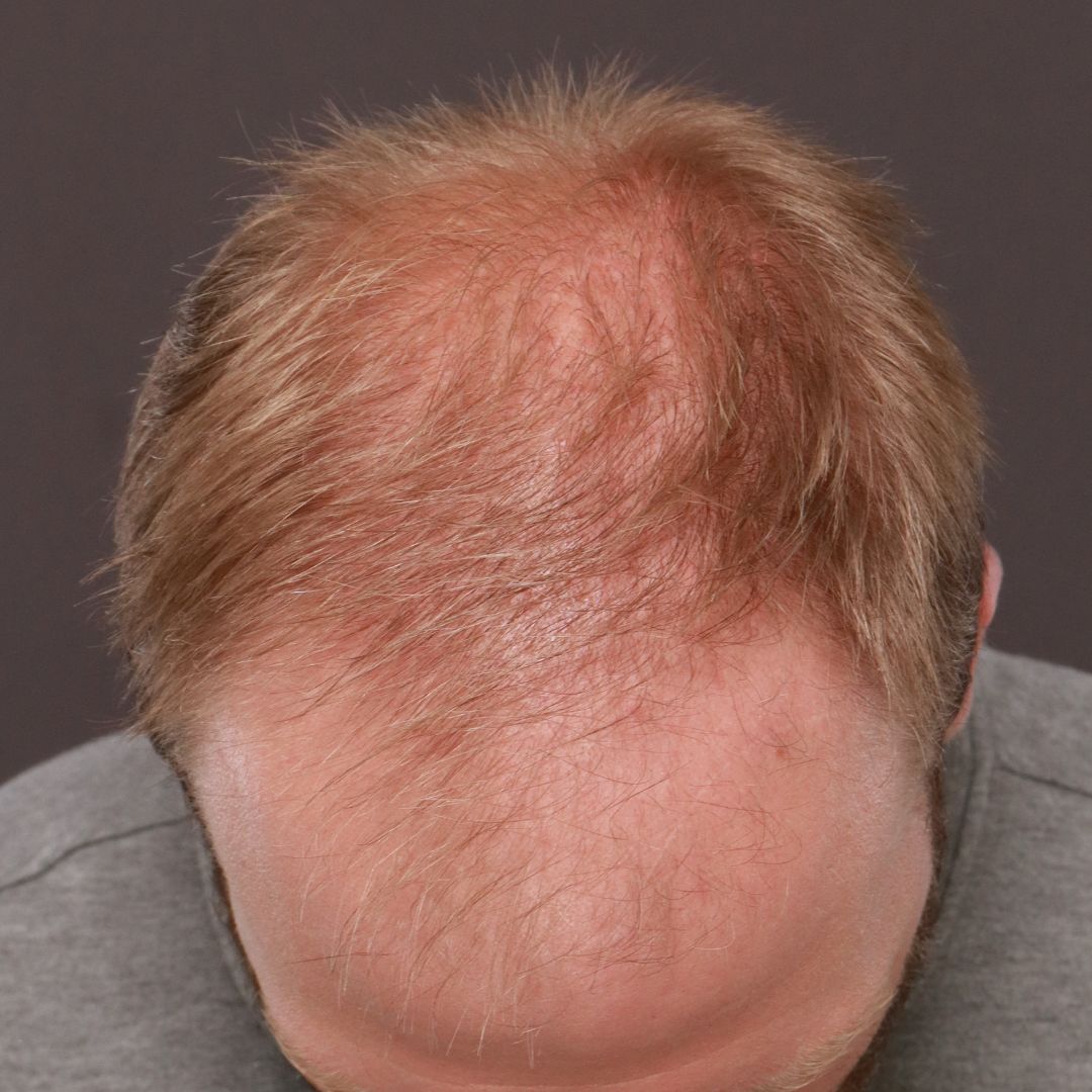 Before Image: FUE Hair Transplant by Dr. Thompson - front