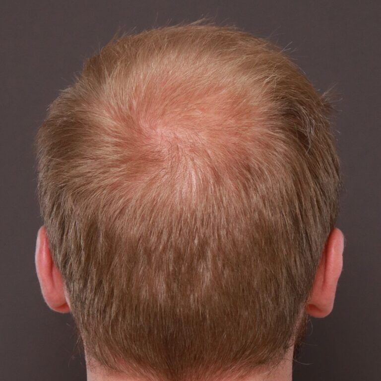 Before Image: FUE Hair Transplant by Dr. Thompson -