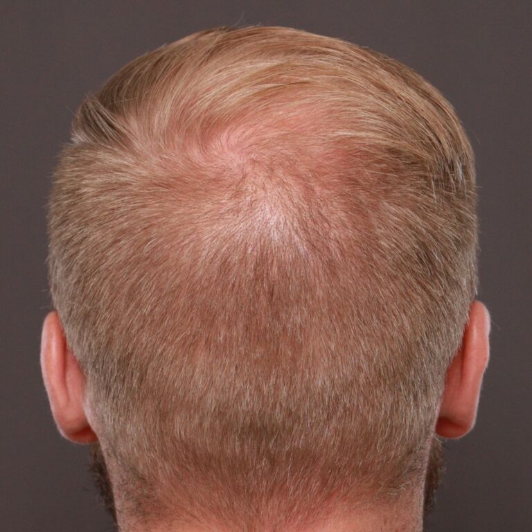 After Image: FUE Hair Transplant by Dr. Thompson -