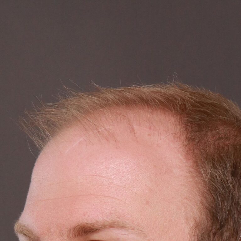 Before Image: FUE Hair Transplant by Dr. Thompson - left-front-oblique