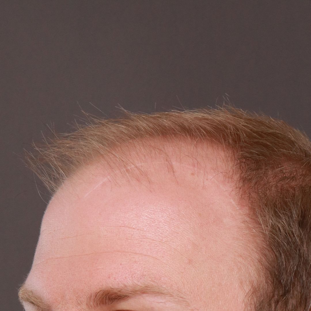 Before Image: FUE Hair Transplant by Dr. Thompson - left-front-oblique