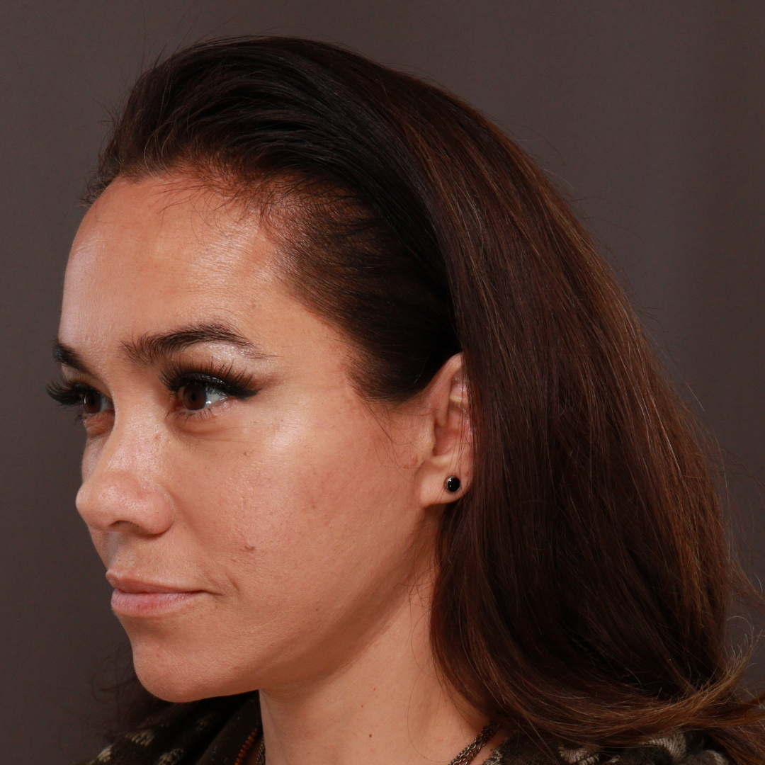 After Image: Forehead Reduction by Dr. Thompson - left-front-oblique