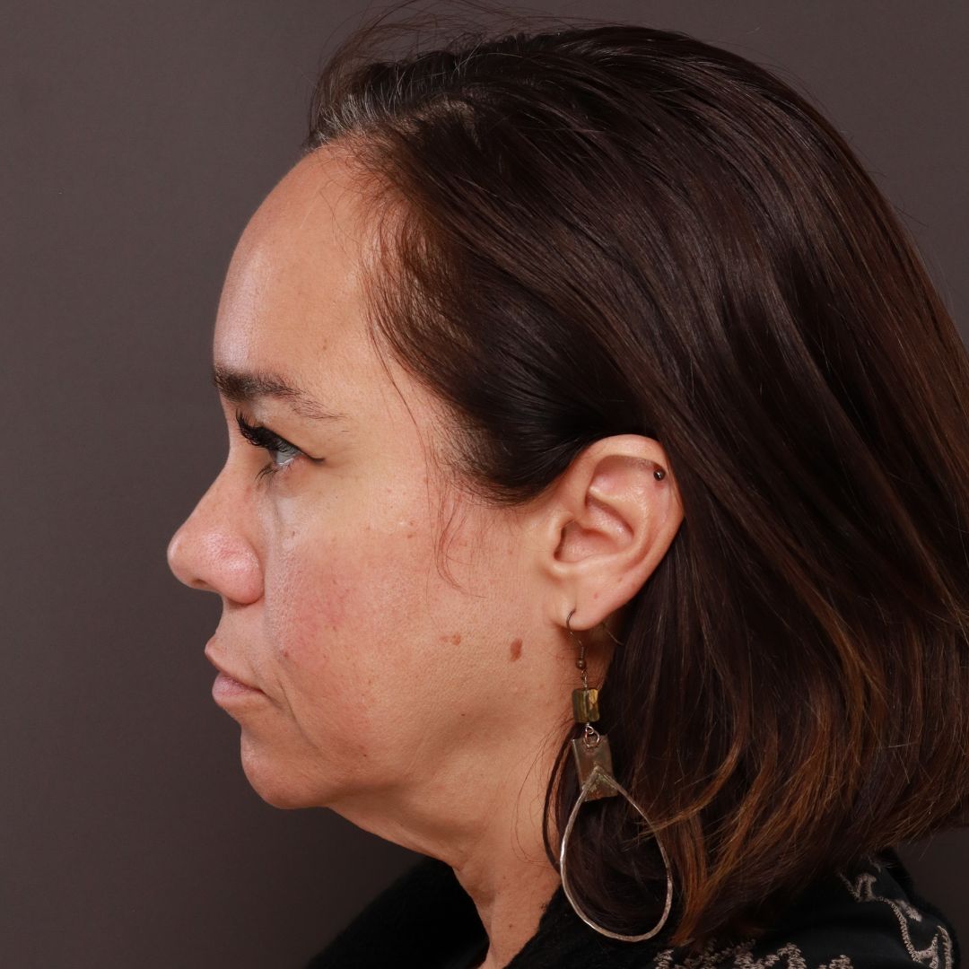 Before Image: Forehead Reduction by Dr. Thompson - left-side
