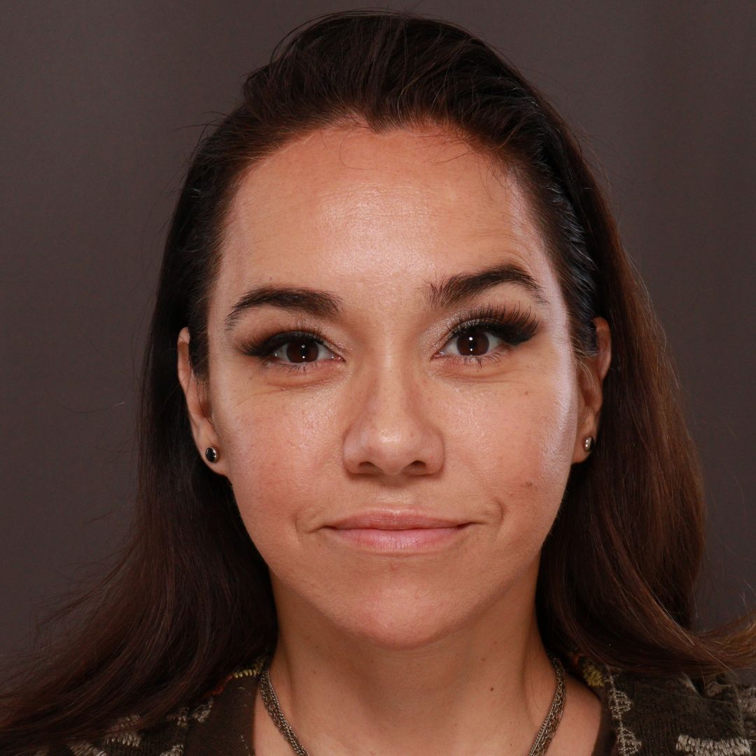 After Image: Forehead Reduction by Dr. Thompson - front