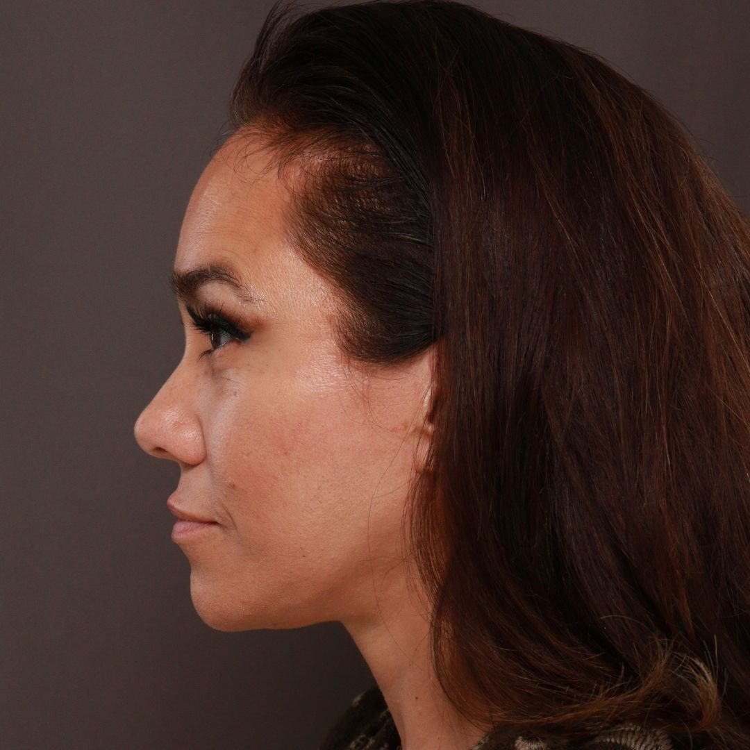 After Image: Forehead Reduction by Dr. Thompson - left-side