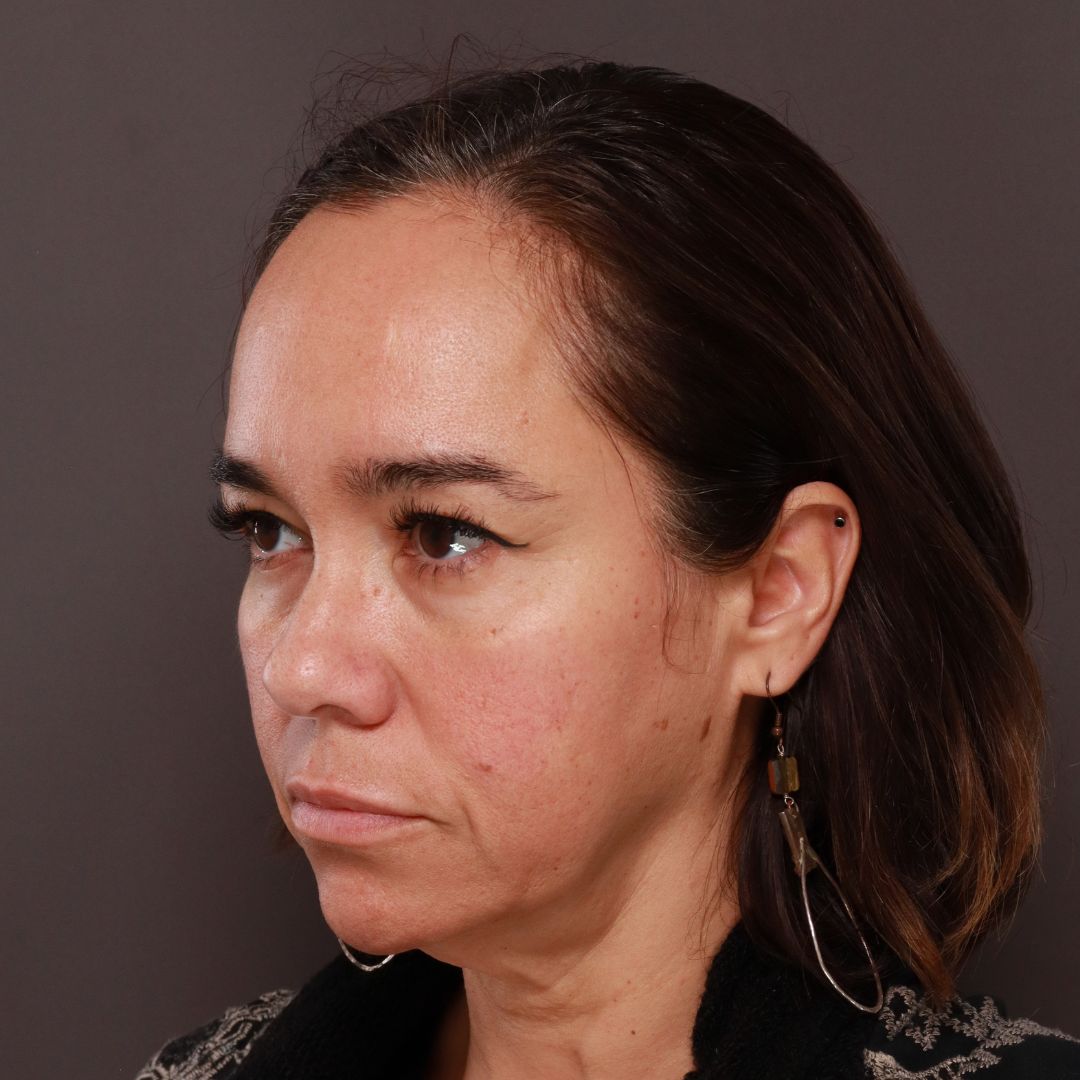 Before Image: Forehead Reduction by Dr. Thompson - left-front-oblique