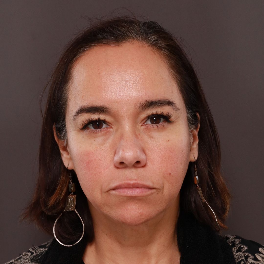 Before Image: Forehead Reduction by Dr. Thompson - front