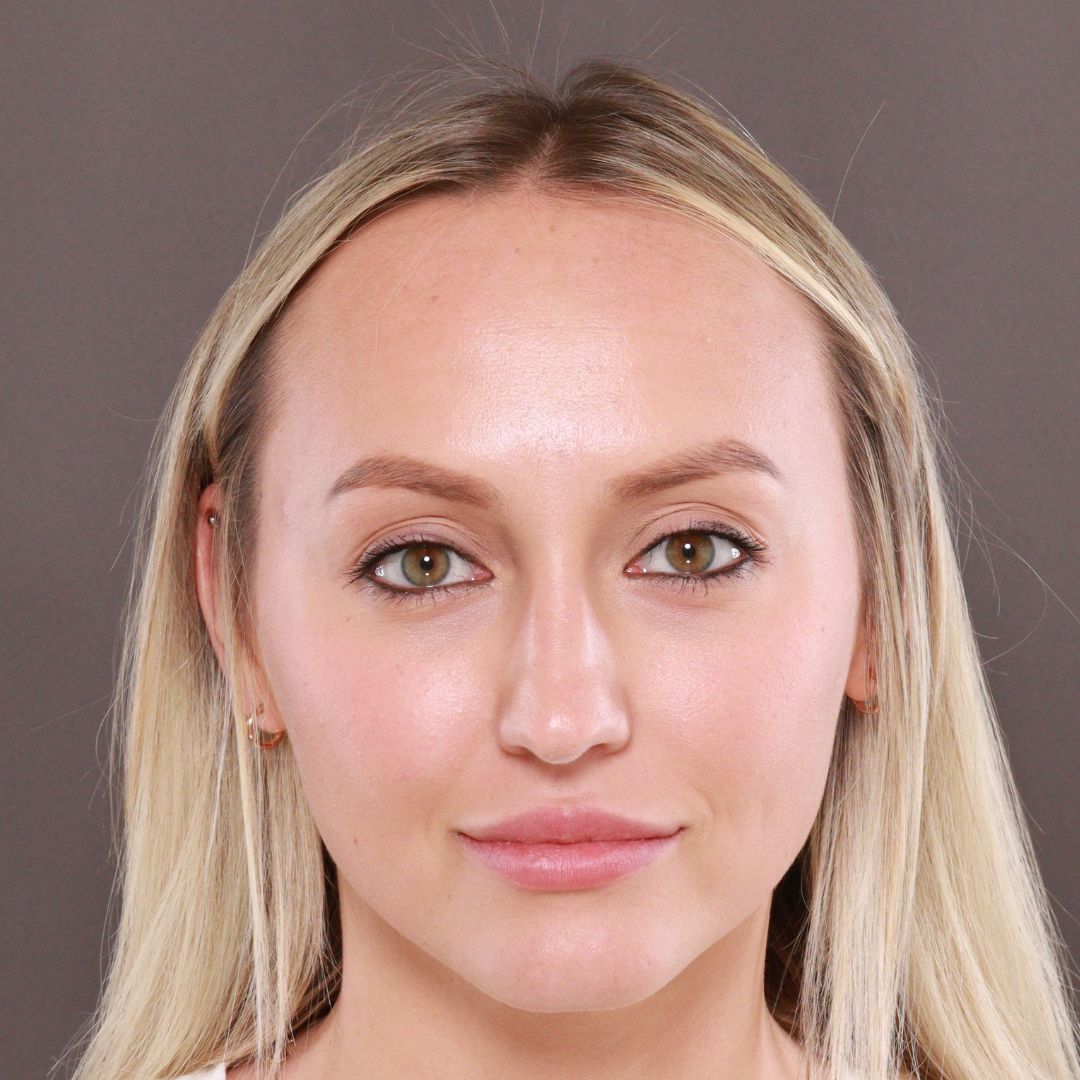 Before Image: Forehead Reduction by Dr. Henstrom - front
