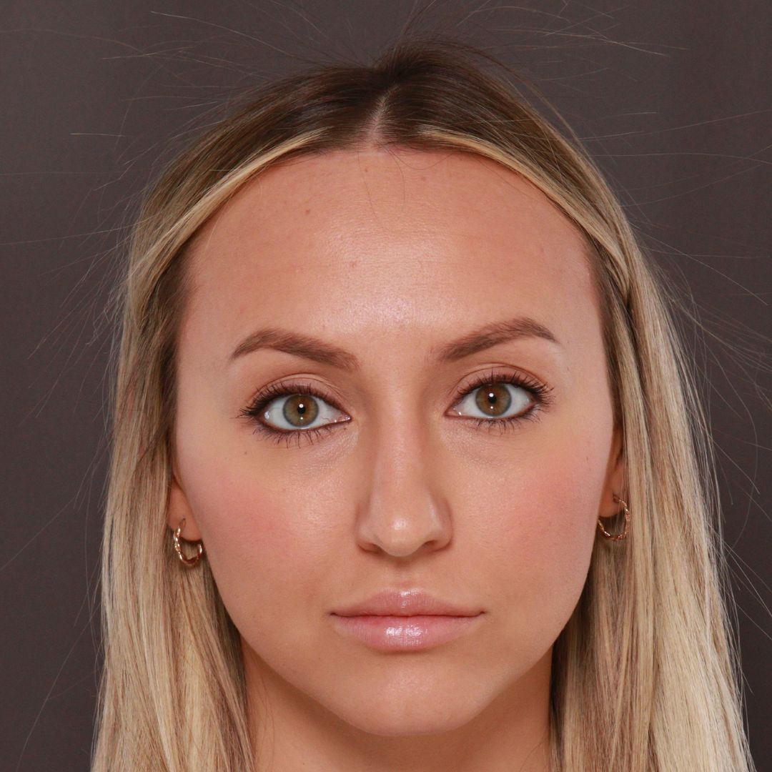 After Image: Forehead Reduction by Dr. Henstrom - front