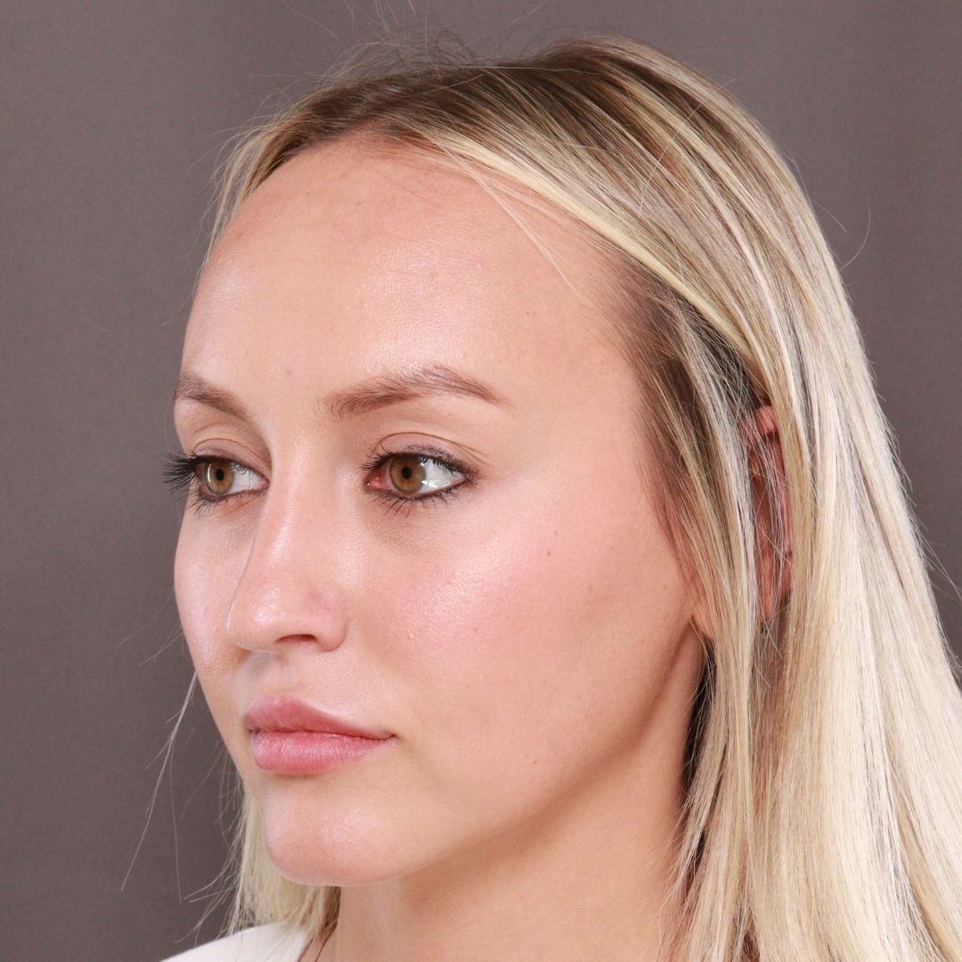 Before Image: Forehead Reduction by Dr. Henstrom - right-front-oblique