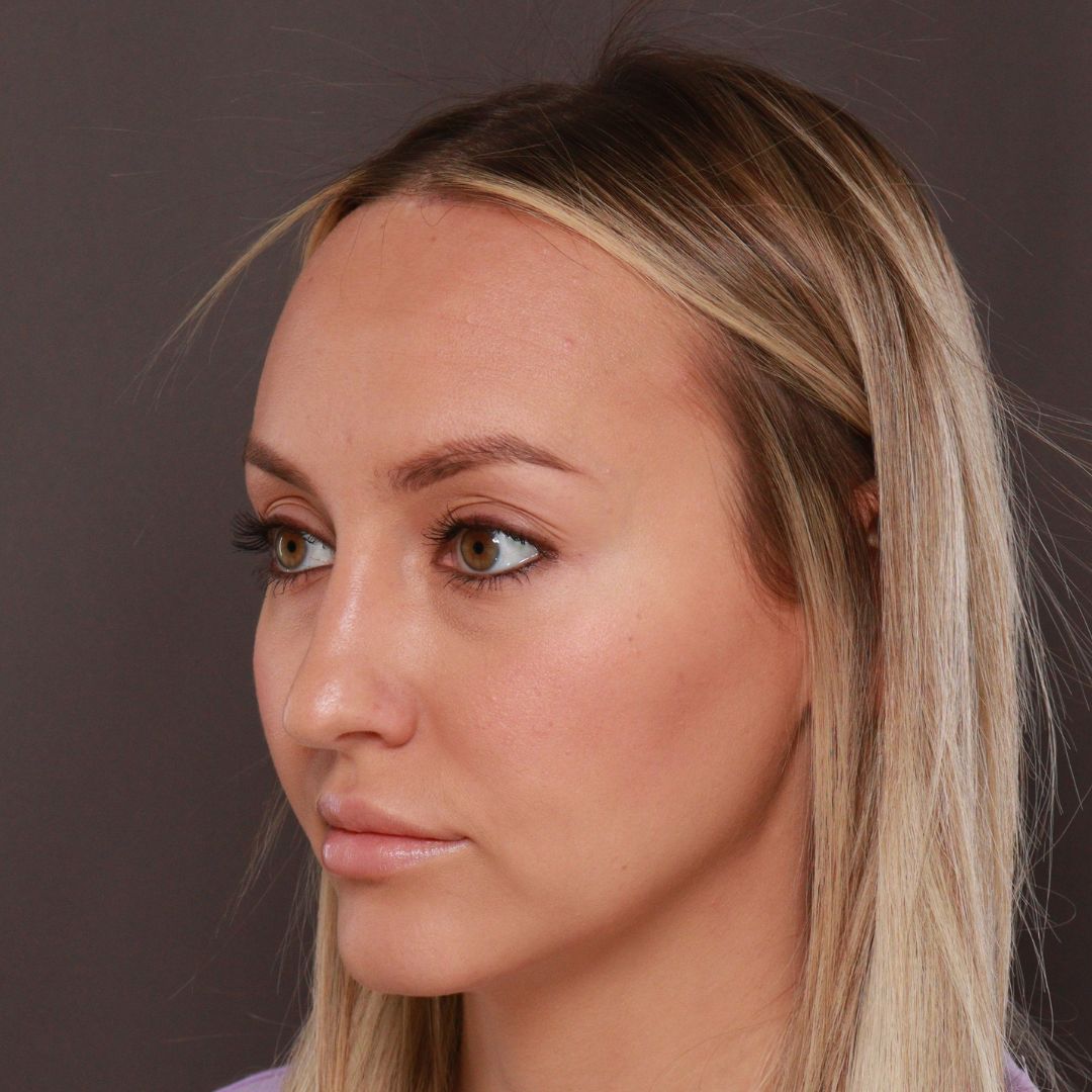 After Image: Forehead Reduction by Dr. Henstrom - right-front-oblique