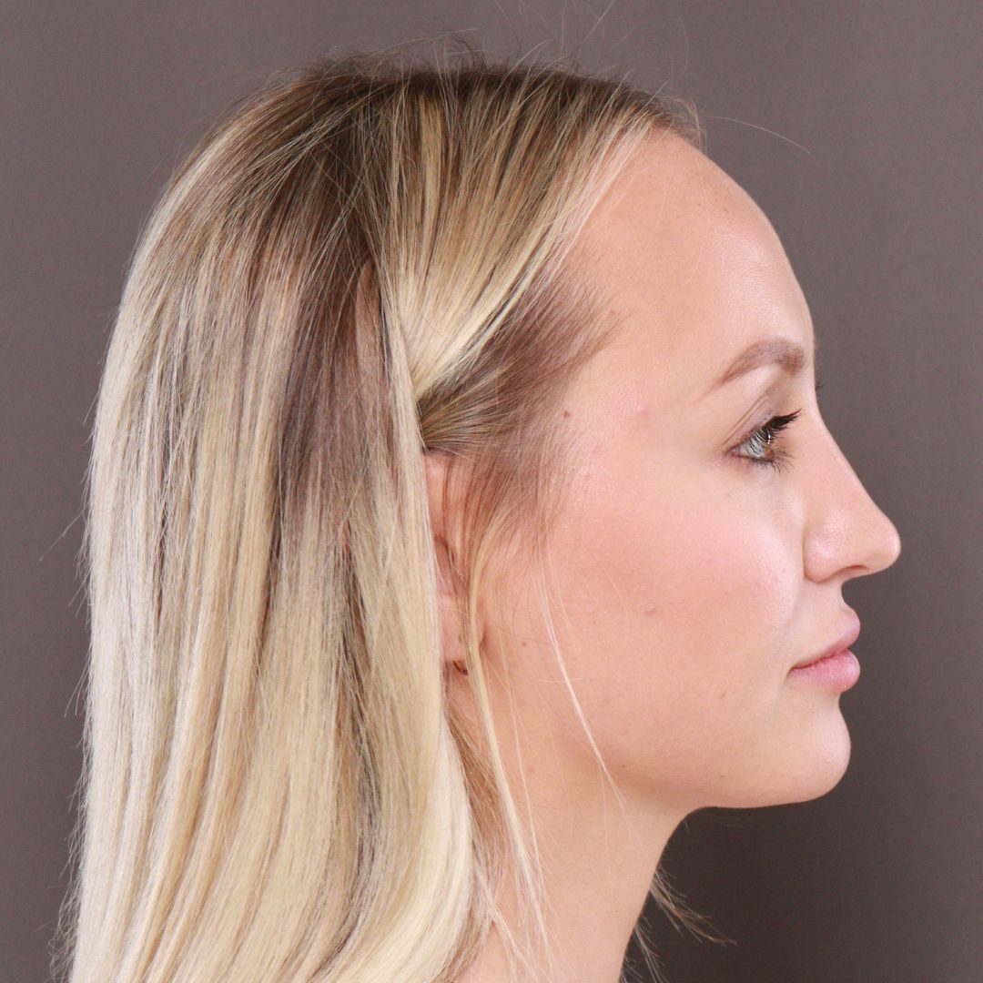 Before Image: Forehead Reduction by Dr. Henstrom - right-side