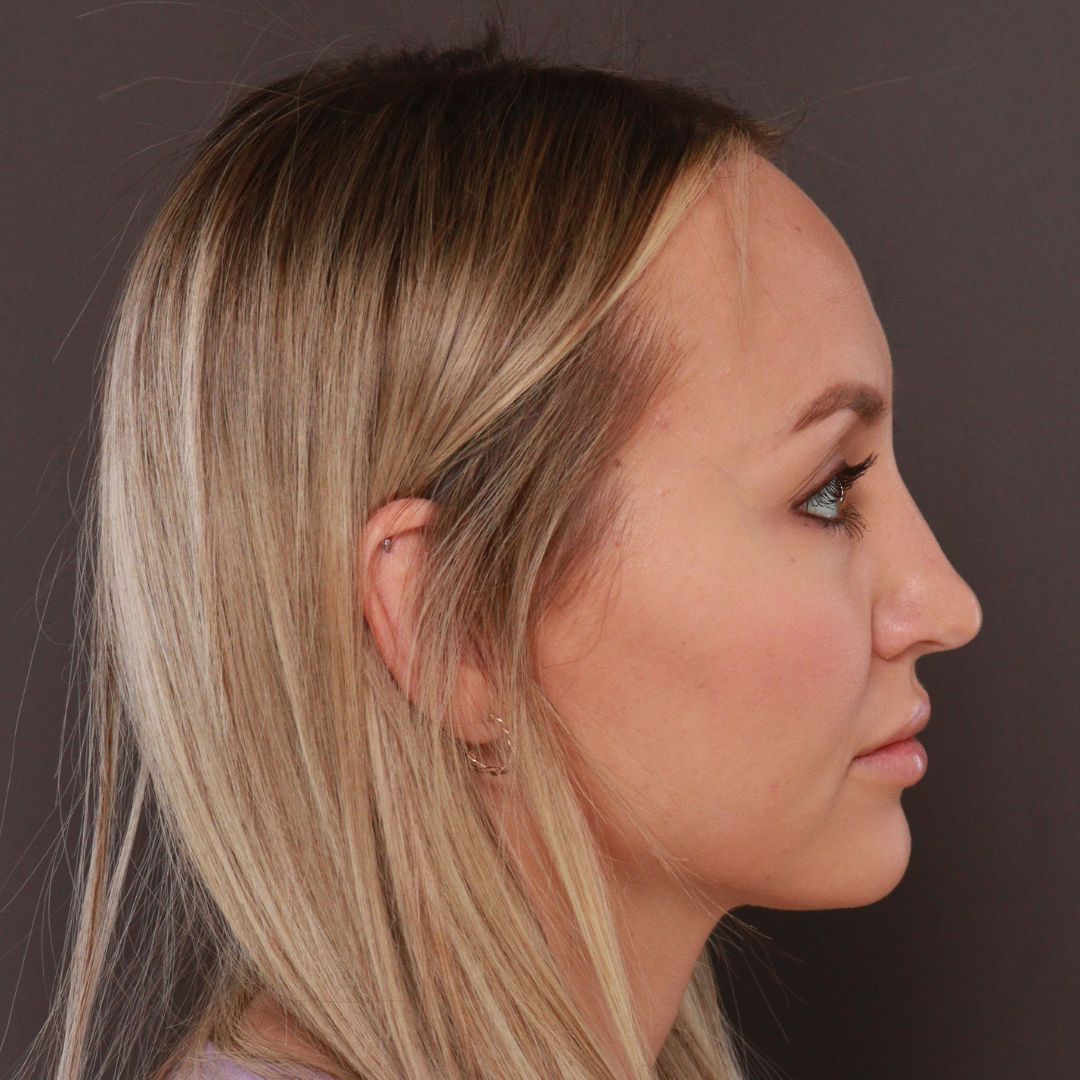 After Image: Forehead Reduction by Dr. Henstrom - right-side