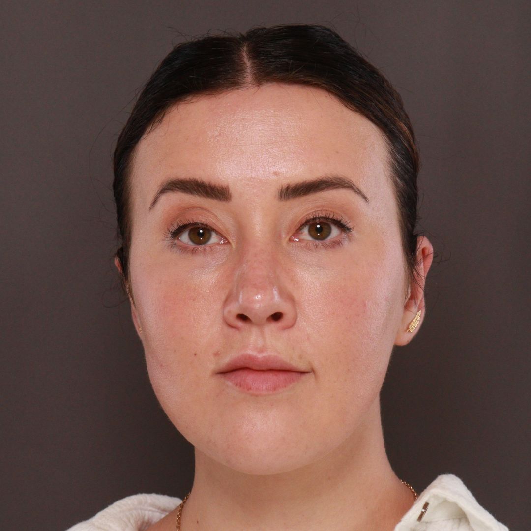 After Image: Forehead Reduction by Dr. Thompson -