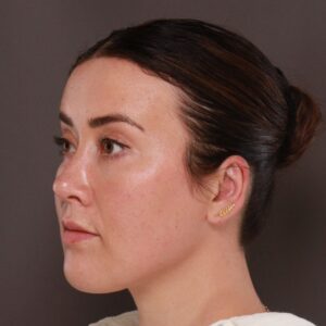After Image: Forehead Reduction by Dr. Thompson