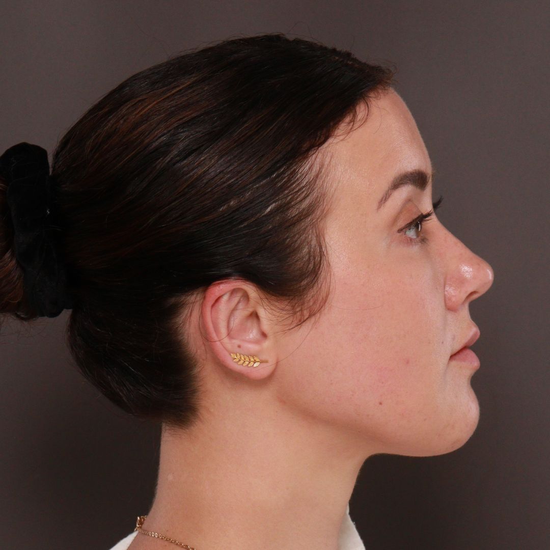 After Image: Forehead Reduction by Dr. Thompson -