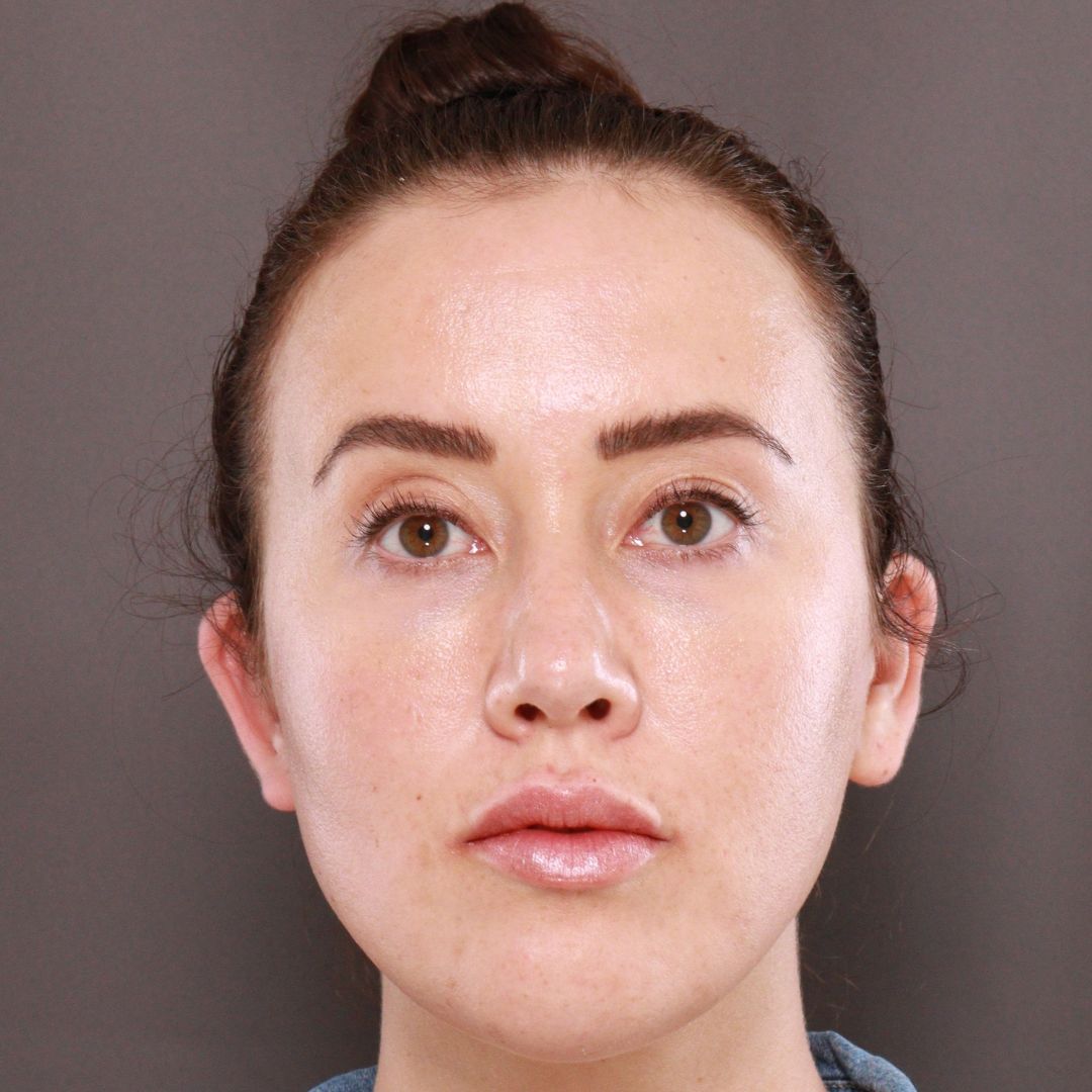Before Image: Forehead Reduction by Dr. Thompson -