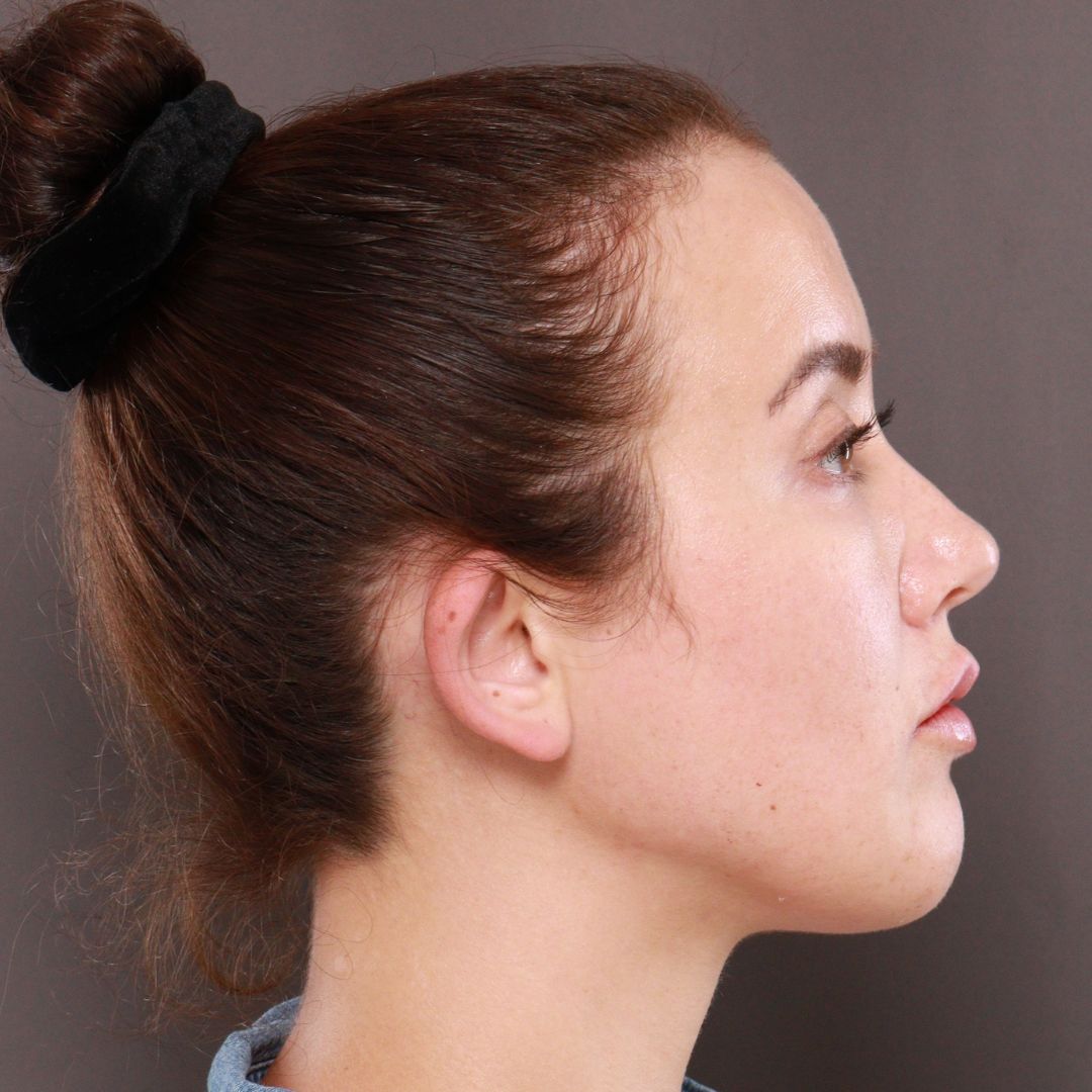 Before Image: Forehead Reduction by Dr. Thompson -