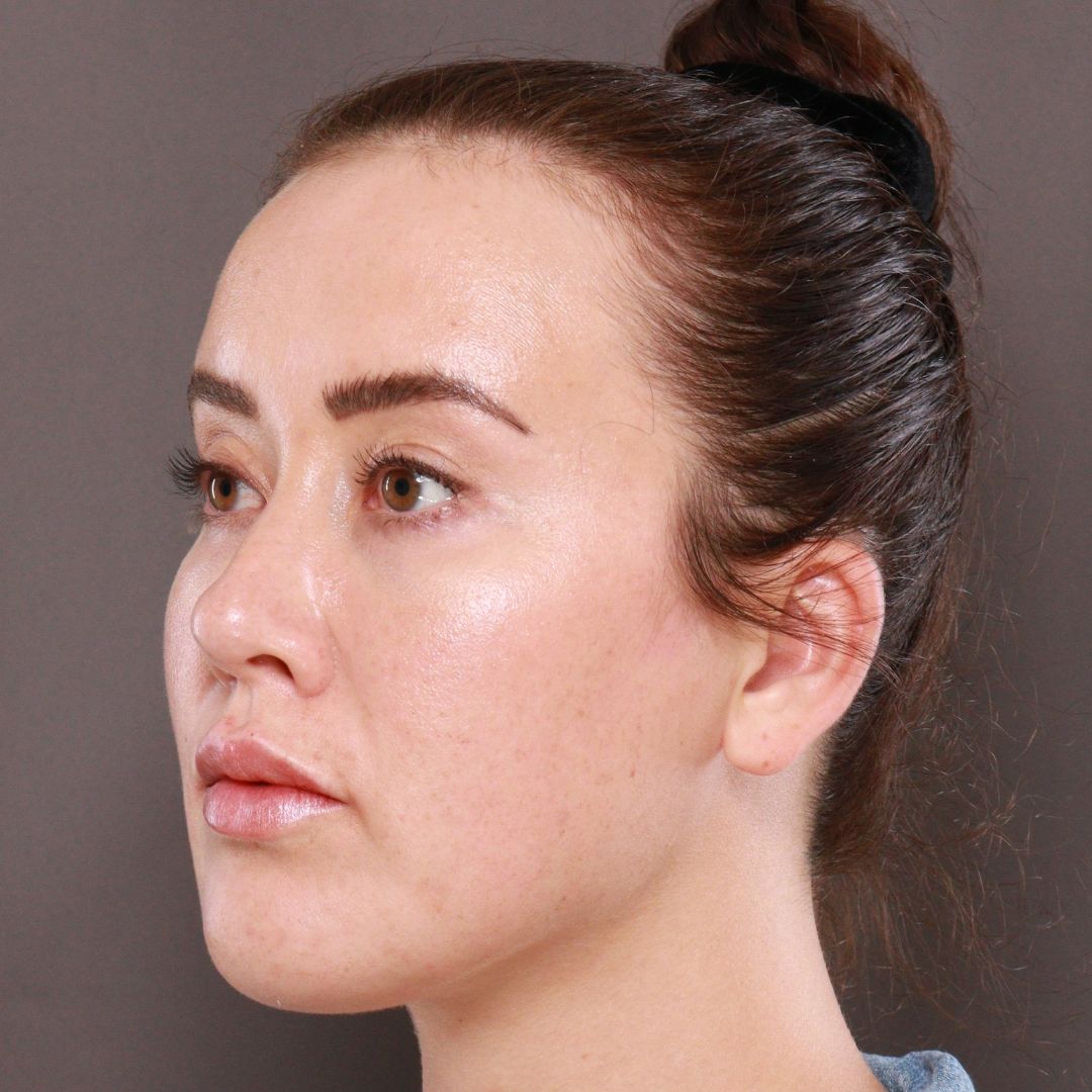 Before Image: Forehead Reduction by Dr. Thompson - left-front-oblique