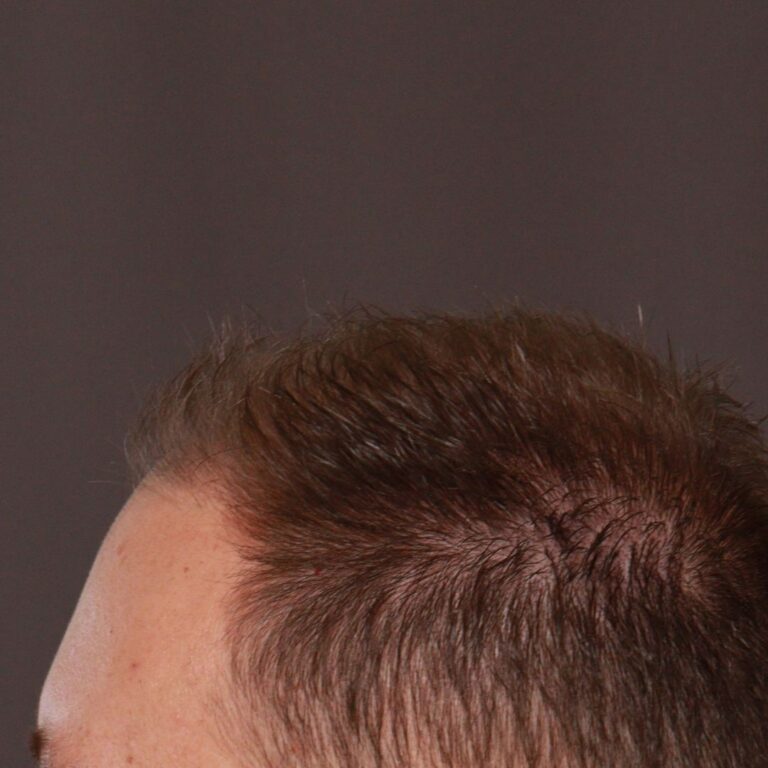 Before Image: FUE Hair Transplant by Dr. Manning -