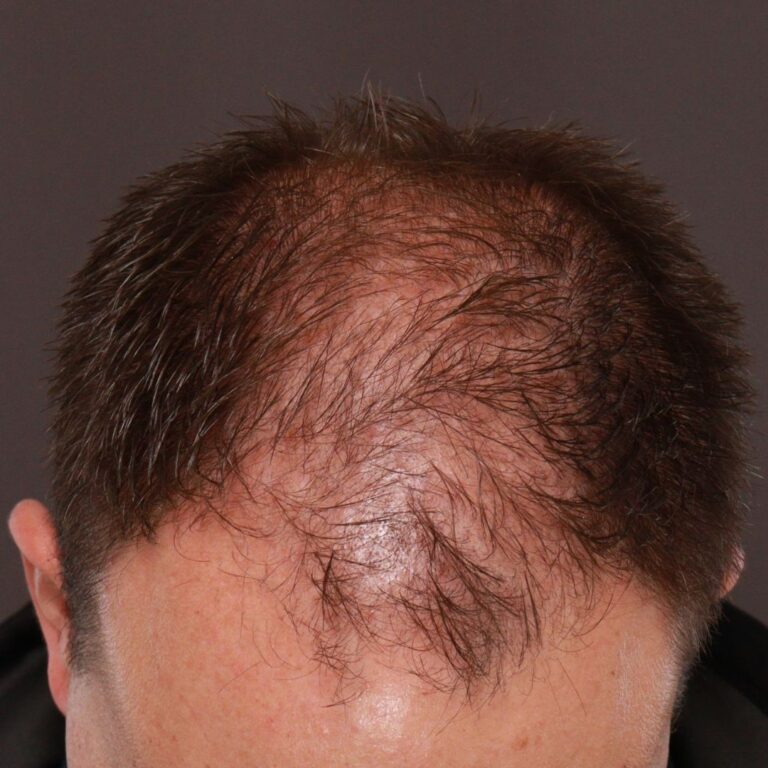 Before Image: FUE Hair Transplant by Dr. Manning - front