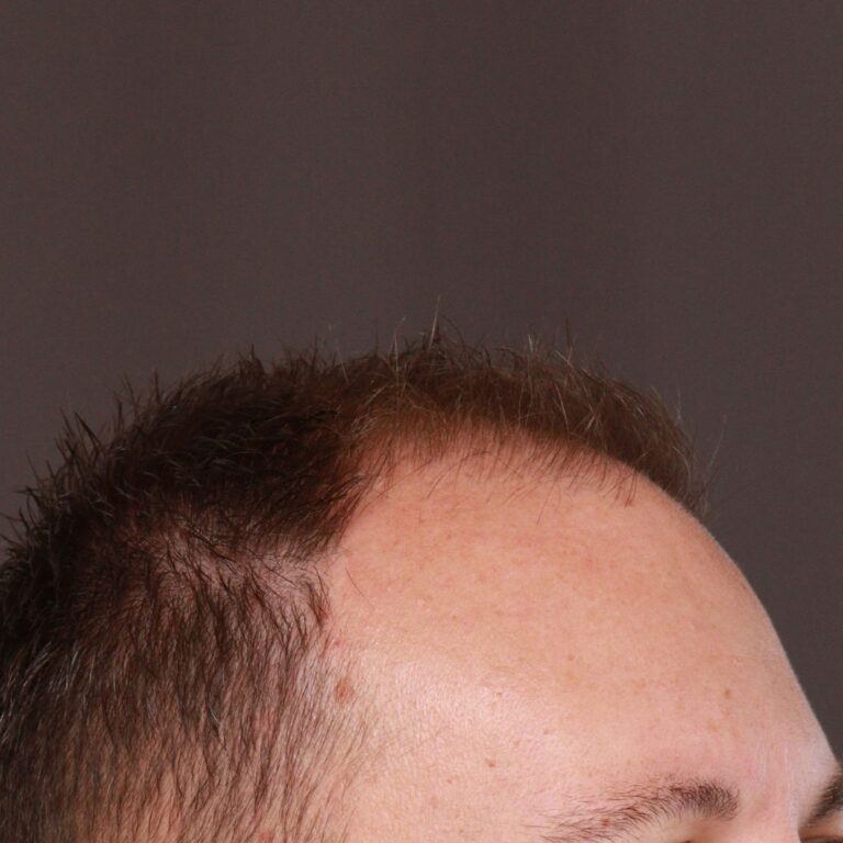 Before Image: FUE Hair Transplant by Dr. Manning -