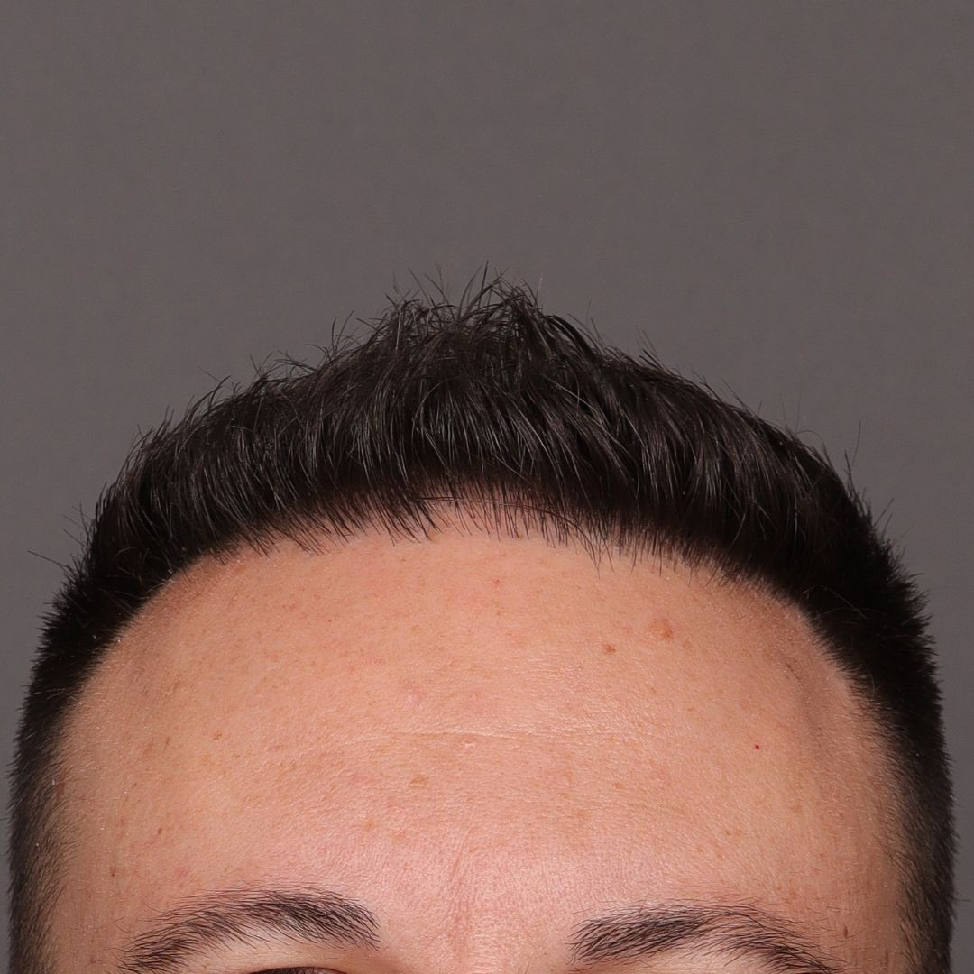 After Image: FUE Hair Transplant by Dr. Manning - front