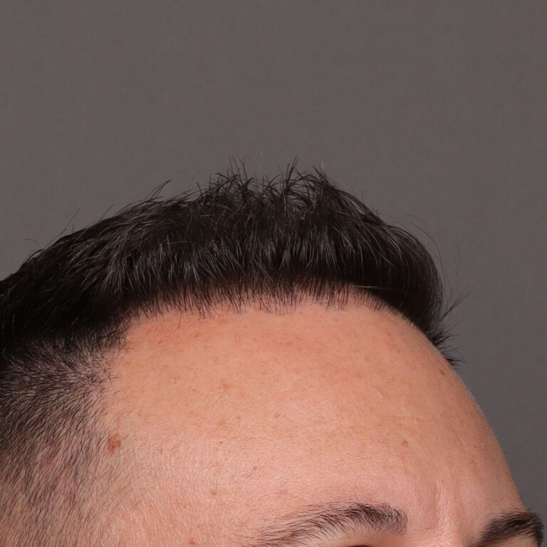 After Image: FUE Hair Transplant by Dr. Manning -