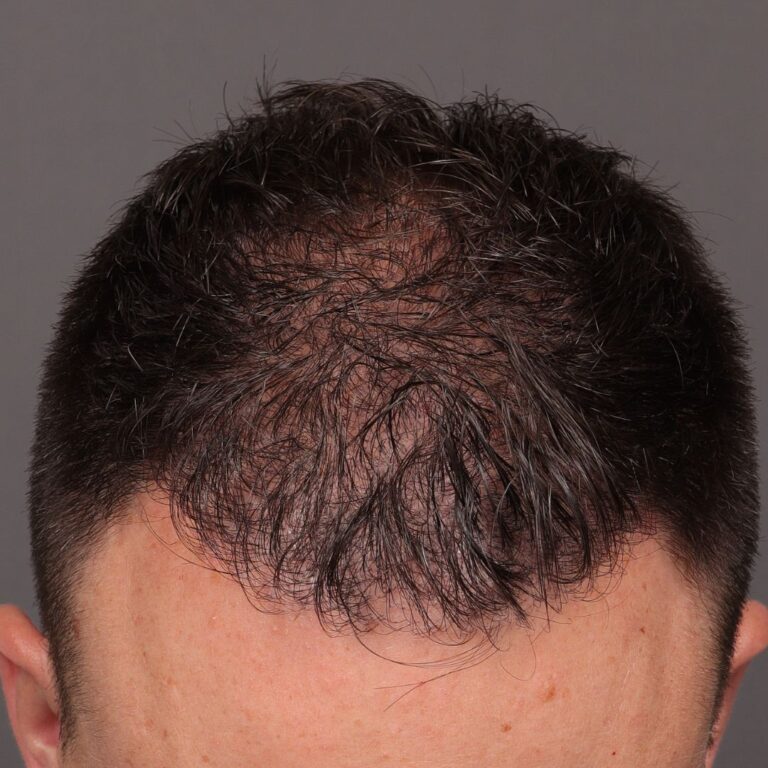After Image: FUE Hair Transplant by Dr. Manning - front